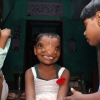 Így él az indiai kétorrú kislány, akit a helyiek istenként tisztelnek