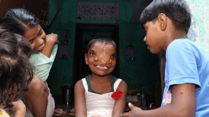 Így él az indiai kétorrú kislány, akit a helyiek istenként tisztelnek
