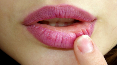 Mit tehetsz a száraz, cserepes ajkak kialakulása ellen?