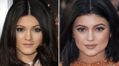 Plasztikai műtéten esett át Kylie Jenner?