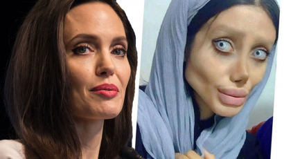 Teljesen tönkretette magát a lány, 50 plasztikai beavatkozással, hogy úgy nézzen ki, mint Angelina Jolie